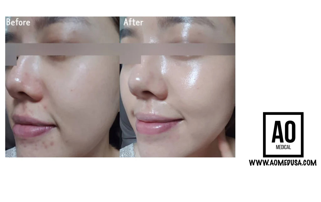 The Filler Facial