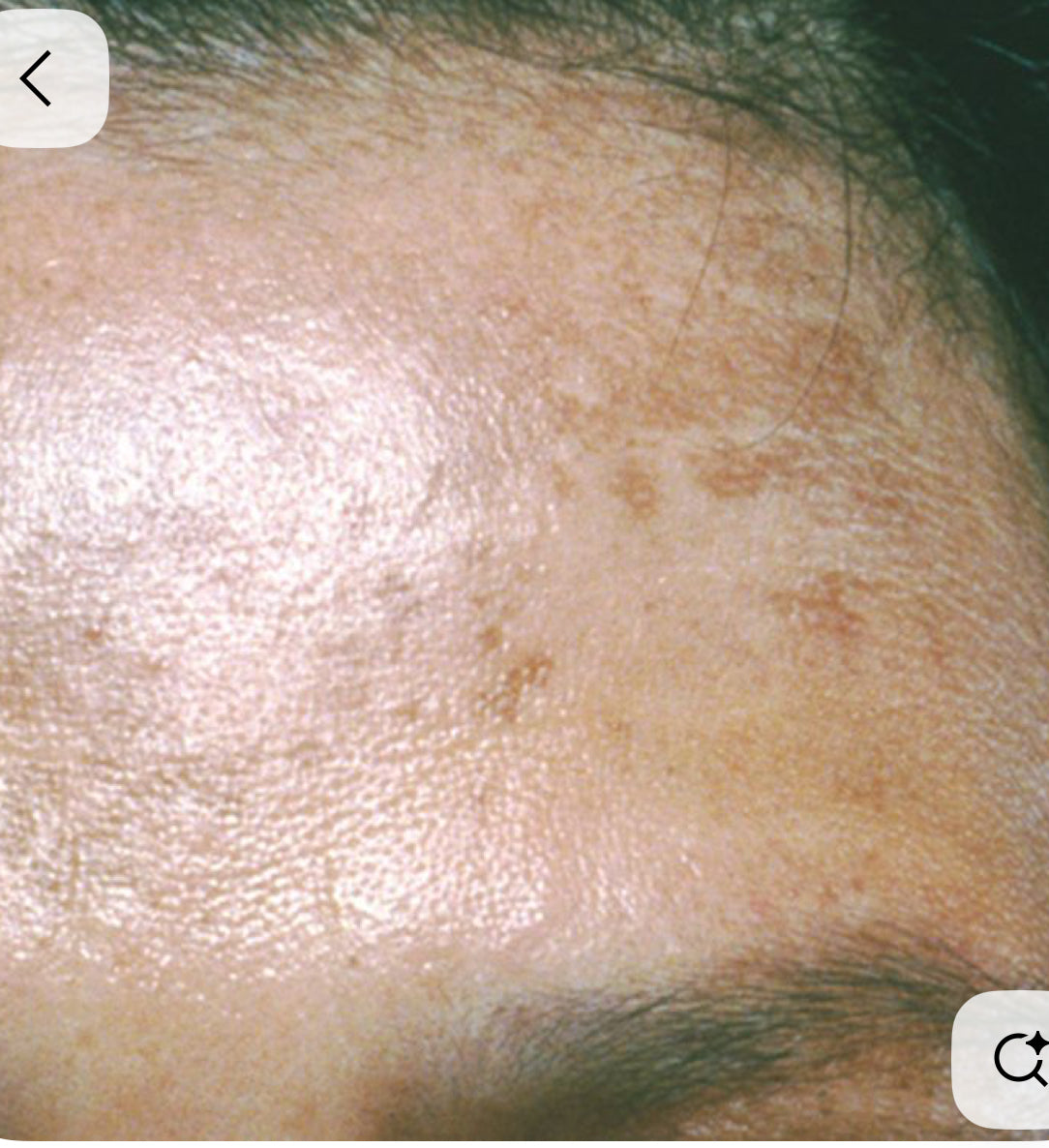 COSMELAN DEPIGMENTATION