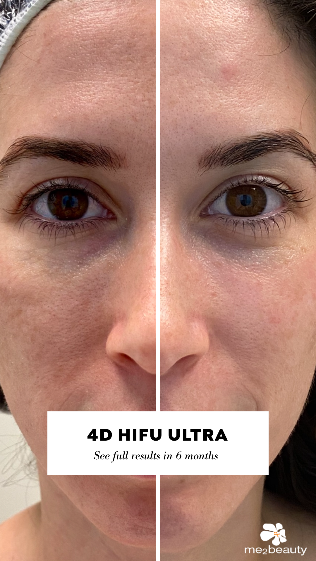 4D HIGH INTENSITY FOCUSED ULTRASOUND (HIFU) - ME2 BEAUTY