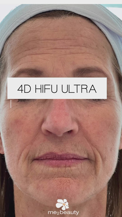 4D HIGH INTENSITY FOCUSED ULTRASOUND (HIFU)