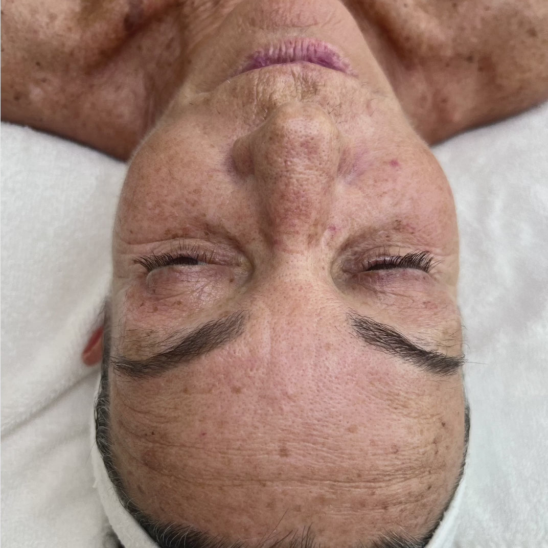 Before and After a Me2 Beauty Grand Facial Extraordinaire with Cold Plasma and Filler Treatment